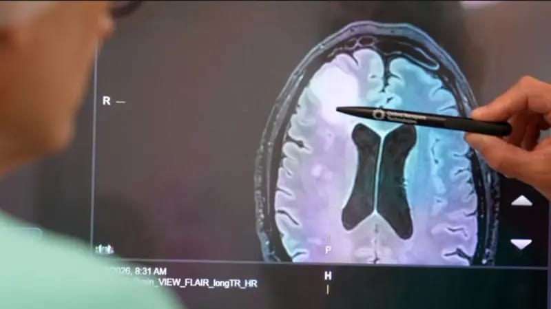 العلاج الإشعاعي قد يمنع عودة بعض أنواع سرطان الدماغ